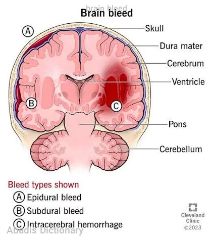 brain bleed
